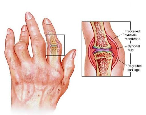 RHEUMATOID ARTHRITIS