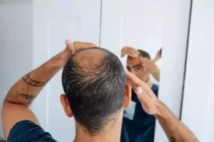 causes of hair loss in men